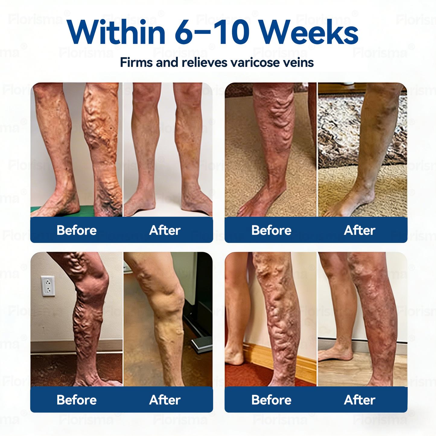 One Patch a Day. Visible Vein Relief in Just 7 Days 👨‍⚕️ 𝑭𝑳𝑶𝑹𝑰𝑺𝑴𝑨® 𝑫𝑰𝑶𝑺𝑴𝑰𝑵 & 𝑯𝑬𝑺𝑷𝑬𝑹𝑰𝑫𝑰𝑵 𝑪𝒍𝒊𝒏𝒊𝒄𝒂𝒍-𝑮𝒓𝒂𝒅𝒆 𝑭𝒐𝒓𝒎𝒖𝒍𝒂 𝑴𝒊𝒄𝒓𝒐𝒏𝒆𝒆𝒅𝒍𝒆 𝑷𝒂𝒕𝒄𝒉 🍀 𝗔𝗱𝘃𝗮𝗻𝗰𝗲𝗱 𝗛𝗲𝗿𝗯𝗮𝗹 𝗕𝗹𝗲𝗻𝗱 𝗧𝗮𝗿𝗴𝗲𝘁𝘀 𝗦𝗽𝗶𝗱𝗲𝗿 𝗩𝗲𝗶𝗻𝘀 & 𝗥𝗲𝗹𝗶𝗲𝘃𝗲𝘀 𝗛𝗲𝗮𝘃𝘆, 𝗧𝗶𝗿𝗲𝗱 𝗟𝗲𝗴𝘀