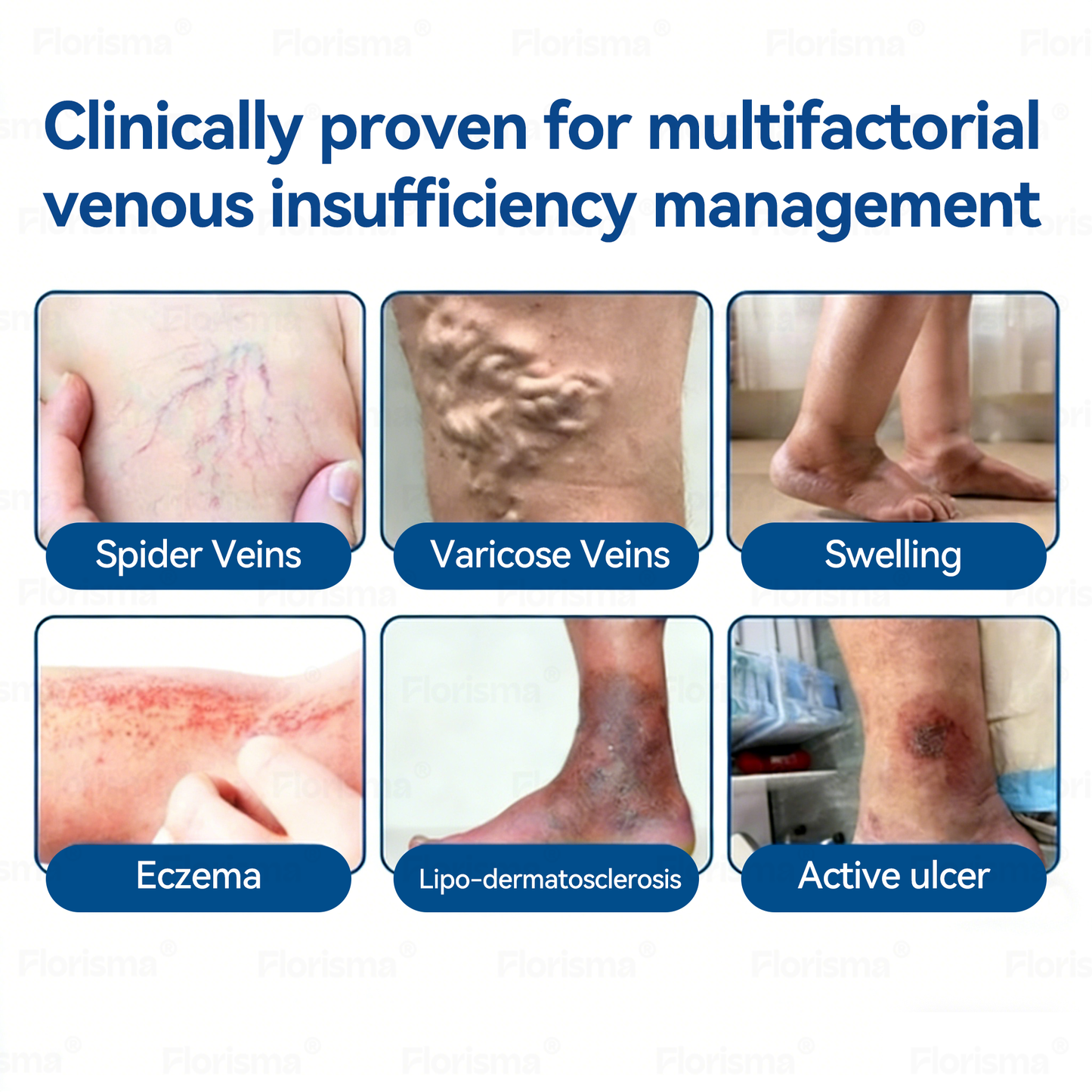 One Patch a Day. Visible Vein Relief in Just 7 Days 👨‍⚕️ 𝑭𝑳𝑶𝑹𝑰𝑺𝑴𝑨® 𝑫𝑰𝑶𝑺𝑴𝑰𝑵 & 𝑯𝑬𝑺𝑷𝑬𝑹𝑰𝑫𝑰𝑵 𝑪𝒍𝒊𝒏𝒊𝒄𝒂𝒍-𝑮𝒓𝒂𝒅𝒆 𝑭𝒐𝒓𝒎𝒖𝒍𝒂 𝑴𝒊𝒄𝒓𝒐𝒏𝒆𝒆𝒅𝒍𝒆 𝑷𝒂𝒕𝒄𝒉 🌿 𝗔𝗱𝘃𝗮𝗻𝗰𝗲𝗱 𝗛𝗲𝗿𝗯𝗮𝗹 𝗕𝗹𝗲𝗻𝗱 𝗧𝗮𝗿𝗴𝗲𝘁𝘀 𝗦𝗽𝗶𝗱𝗲𝗿 𝗩𝗲𝗶𝗻𝘀 & 𝗥𝗲𝗹𝗶𝗲𝘃𝗲𝘀 𝗛𝗲𝗮𝘃𝘆, 𝗧𝗶𝗿𝗲𝗱 𝗟𝗲𝗴𝘀
