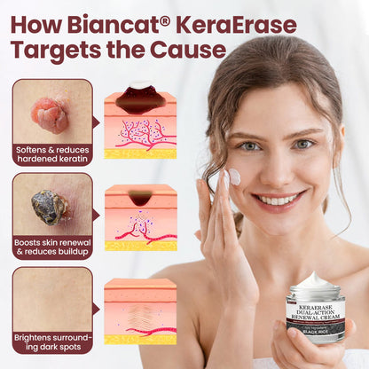 💕DORMORNA® KeraErase Dual-Action Renewal Cream