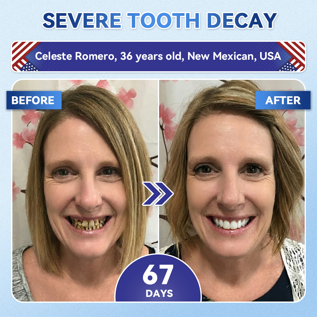 Glimmerly® 🦷 Tideglusib Fast‑Dissolving Tooth & Gum Repair Oral Strips 💖 (Supports tooth repair and helps relieve gum discomfort and other common oral concerns)