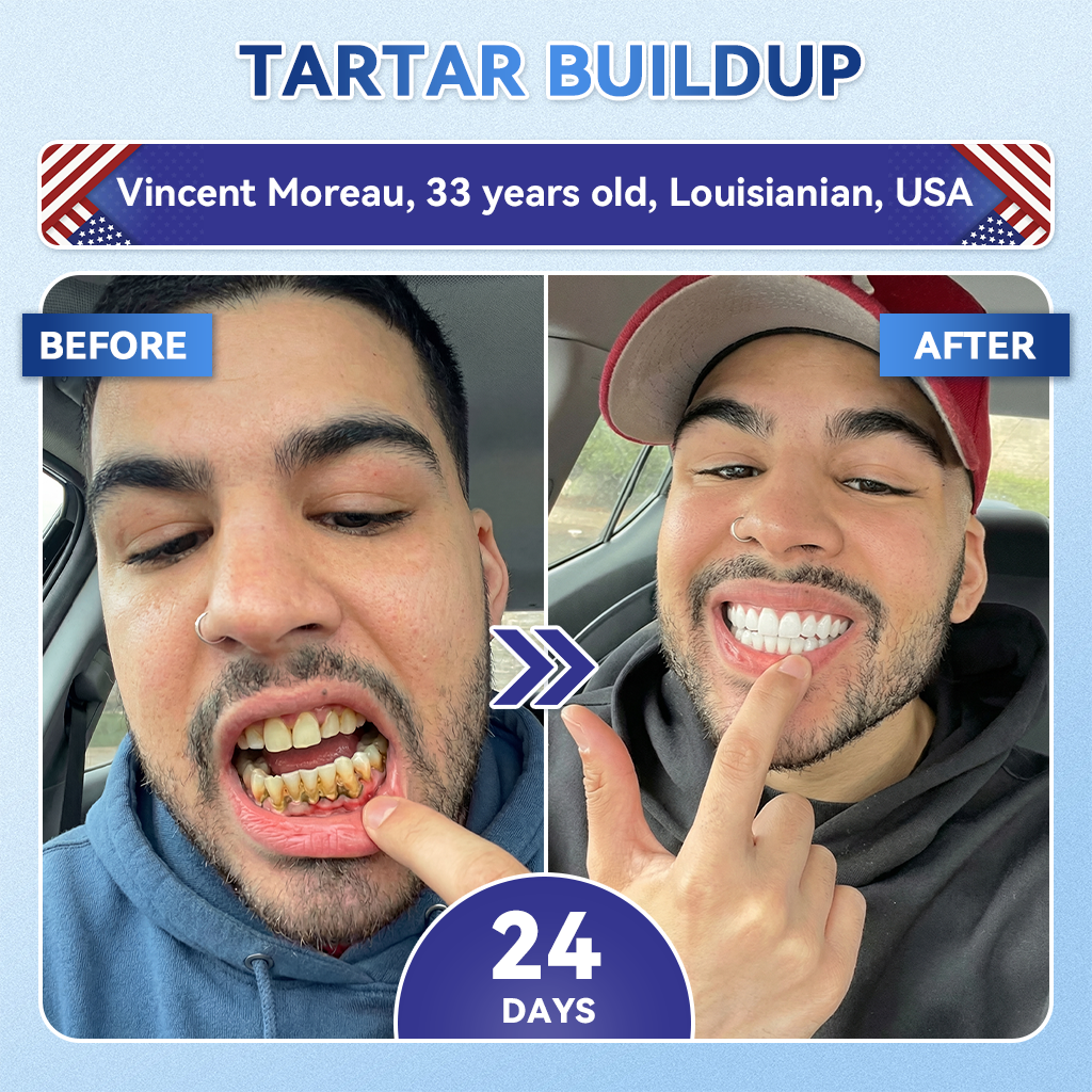 Glimmerly® 🦷 Tideglusib Fast‑Dissolving Tooth & Gum Repair Oral Strips 💖 (Supports tooth repair and helps relieve gum discomfort and other common oral concerns)